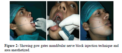 annals-medical-health-sciences-mandibular-nerve