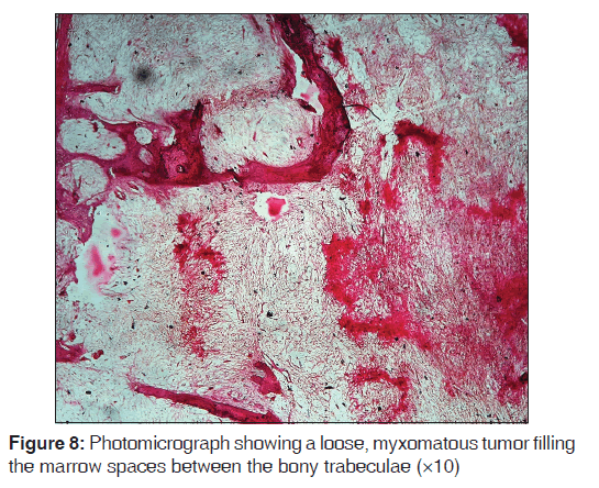 annals-medical-health-sciences-marrow-spaces-bony-trabeculae