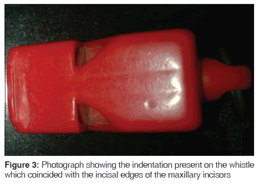 annals-medical-health-sciences-maxillary-incisors