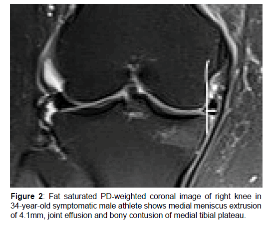 annals-medical-health-sciences-meniscus-extrusion