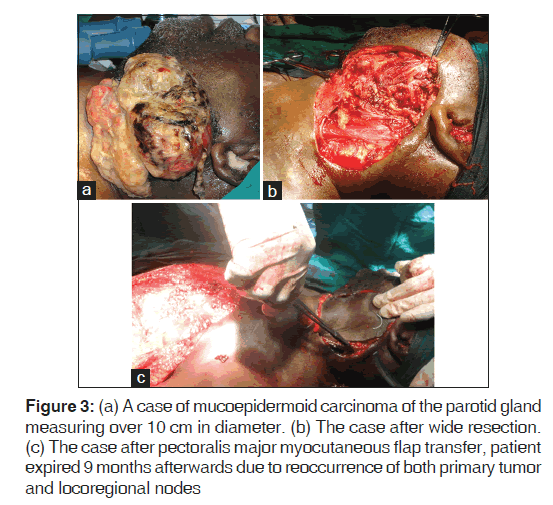 annals-medical-health-sciences-mucoepidermoid