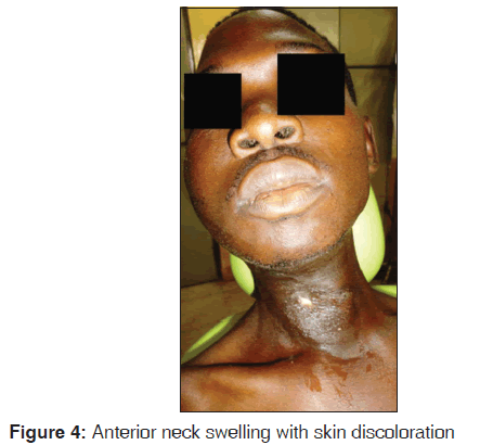 annals-medical-health-sciences-neck-swelling