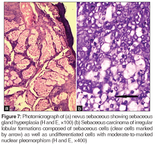 annals-medical-health-sciences-nevus-sebaceous