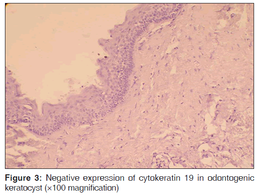 annals-medical-health-sciences-odontogenic-keratocyst