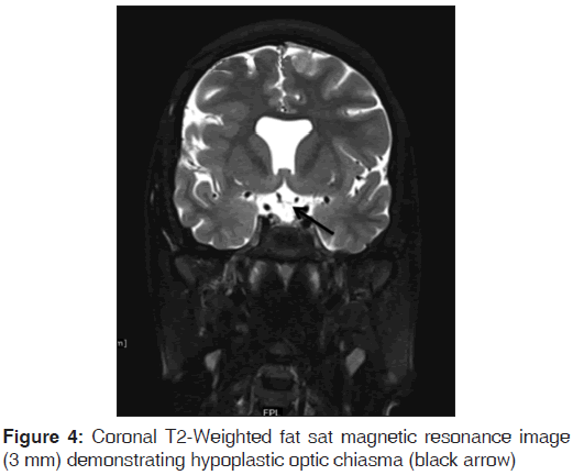 annals-medical-health-sciences-optic-chiasma