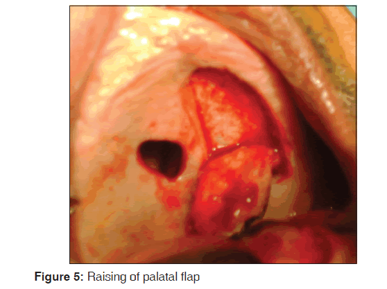 annals-medical-health-sciences-palatal