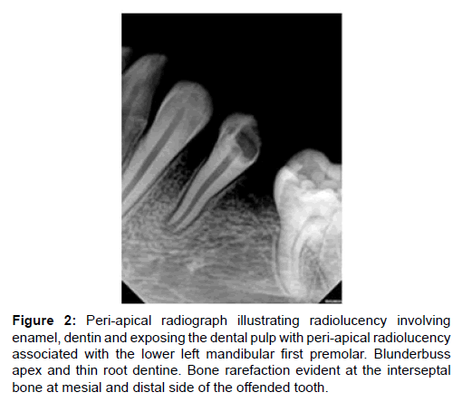 annals-medical-health-sciences-peri-apical