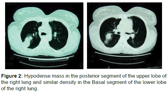 annals-medical-health-sciences-posterior-segment