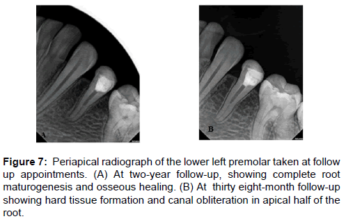 annals-medical-health-sciences-premolar