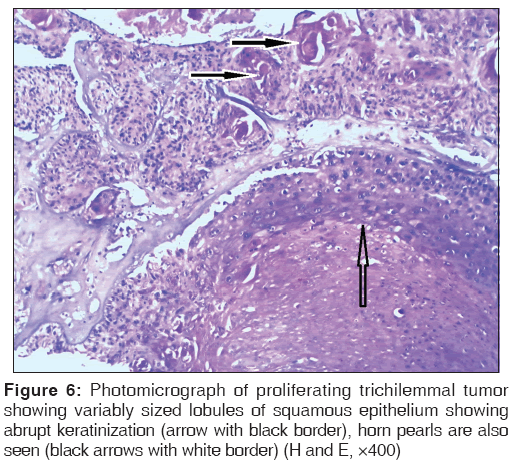 annals-medical-health-sciences-proliferating-trichilemmal