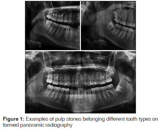 annals-medical-health-sciences-pulp-stones