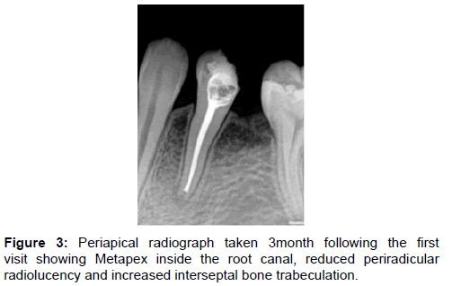 annals-medical-health-sciences-radiolucency