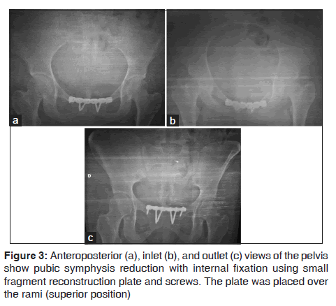 annals-medical-health-sciences-reconstruction-plate