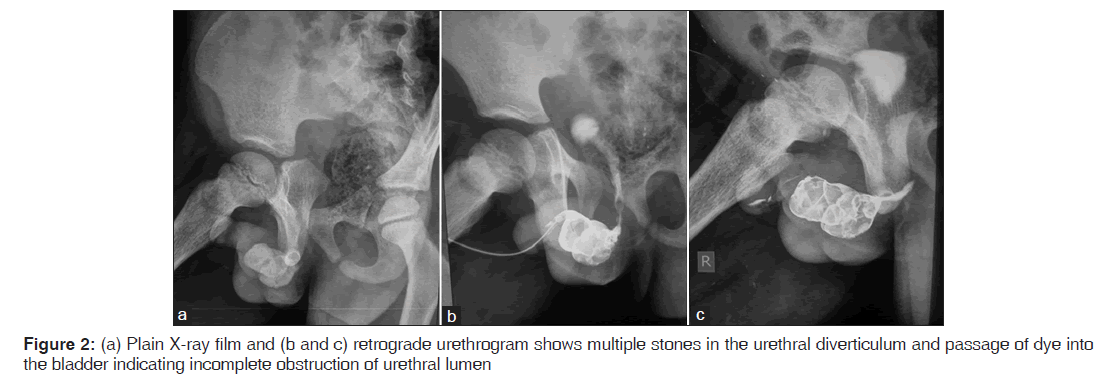 annals-medical-health-sciences-retrograde-urethrogram-multiple-stones