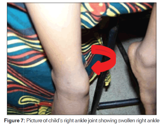 annals-medical-health-sciences-right-ankle-joint-showing-swollen