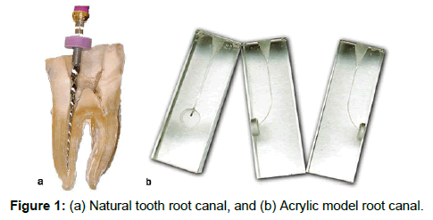 annals-medical-health-sciences-root-canal