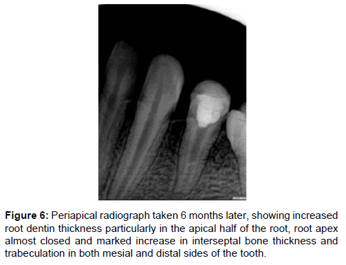 annals-medical-health-sciences-root-dentin