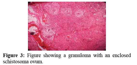 annals-medical-health-sciences-schistosoma-ovum