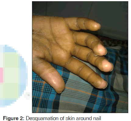 annals-medical-health-sciences-skin-around-nail