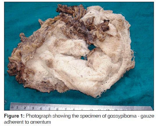 annals-medical-health-sciences-specimen-gossypiboma-gauze-adherent-omentum