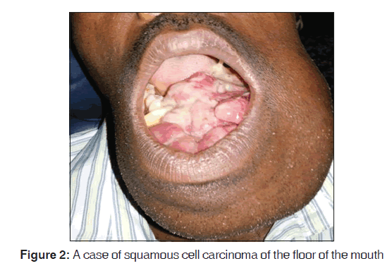 annals-medical-health-sciences-squamous