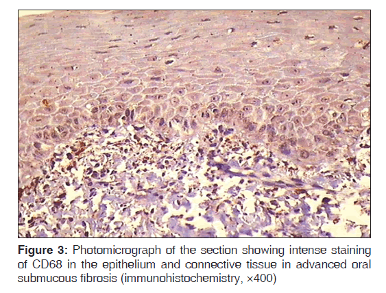 annals-medical-health-sciences-submucous-fibrosis