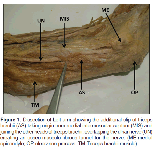 annals-medical-health-sciences-taking-origin-medial-intermuscular-septum