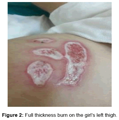annals-medical-health-sciences-thickness-burn