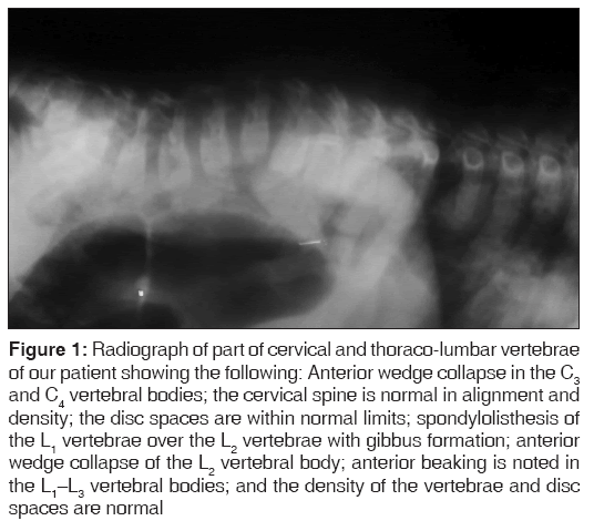 annals-medical-health-sciences-thoraco-lumbar