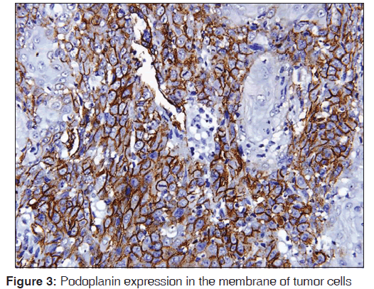 annals-medical-health-sciences-tumor-cells