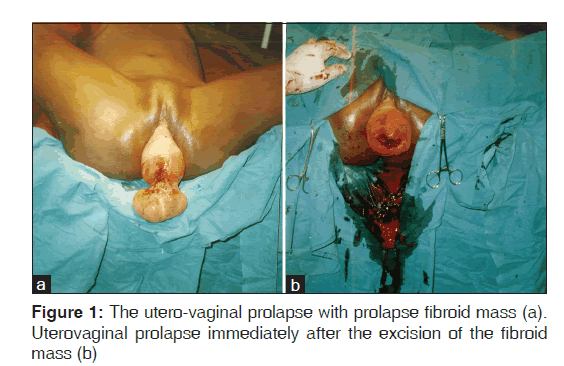 annals-medical-health-sciences-utero-vaginal