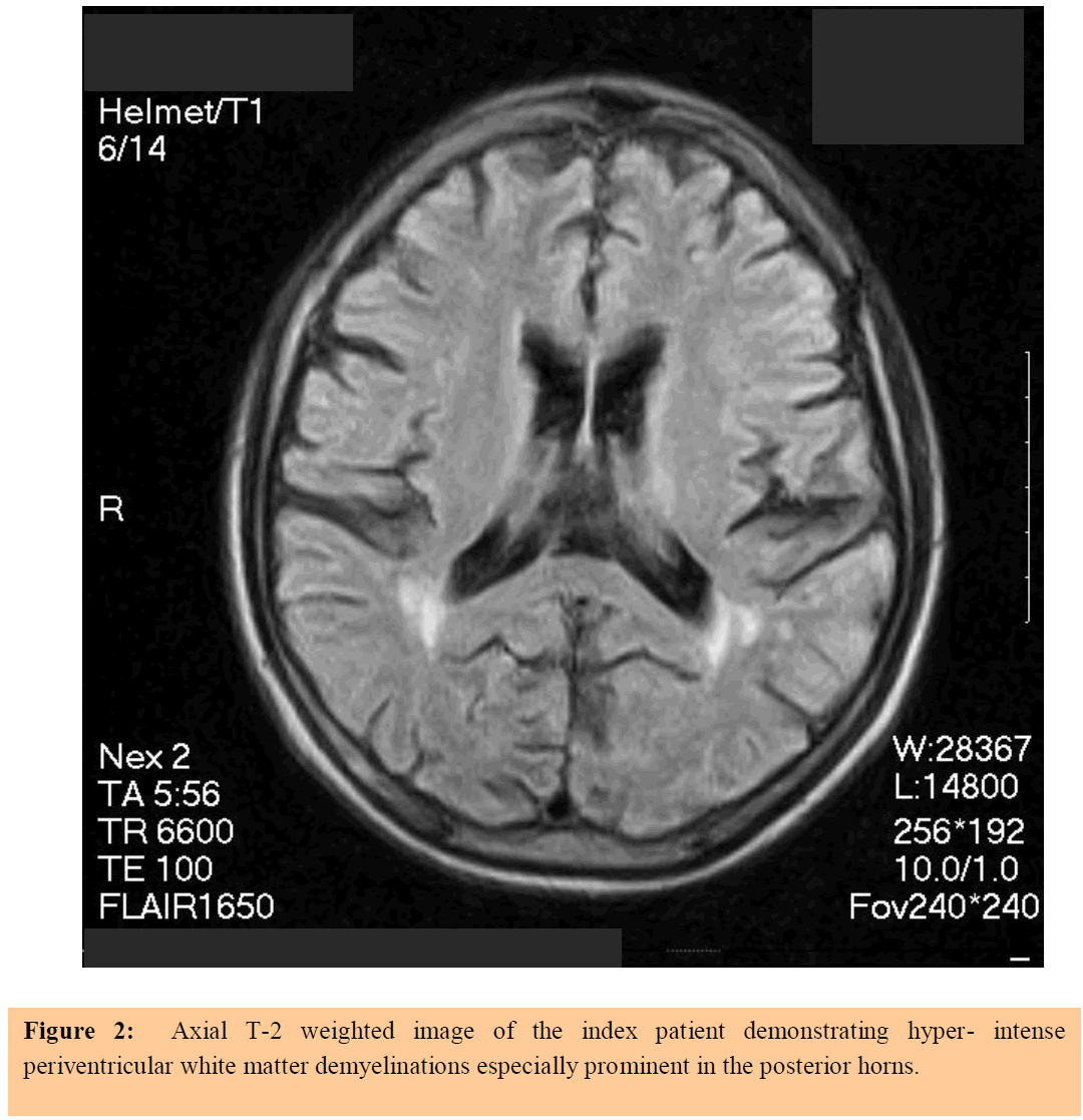 annals-medical-health-sciences-white-matter