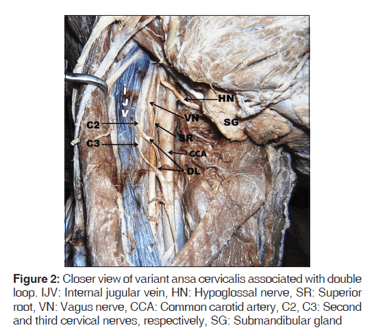 annals-medical-health-variant-ansa-cervicalis