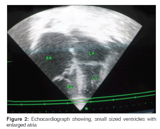 annals-medical-health-ventricles-enlarged-atria