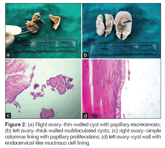 annals-medical-health-walled-multiloculated-cysts