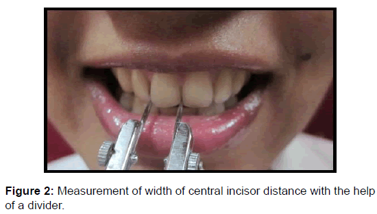 annals-medical-health-width-central-incisor