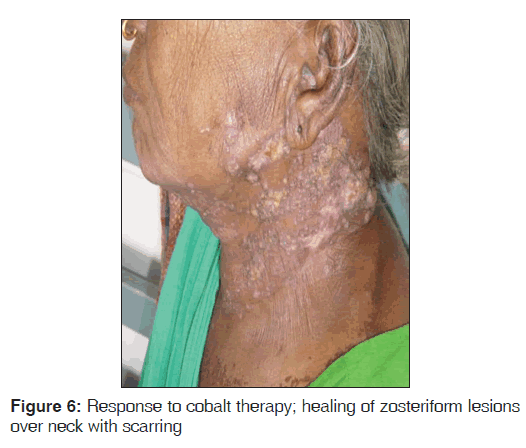 annals-medical-health-zosteriform-lesions