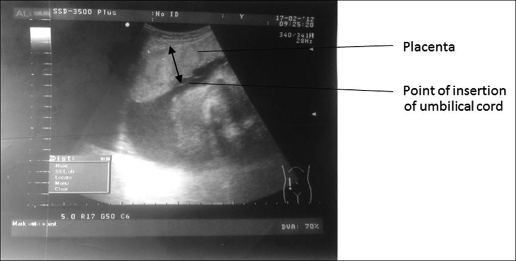 Peripheral and Central Nervous System Involvement in Recently Diagnosed Cases of Hypothyroidism: An Electrophysiological Study