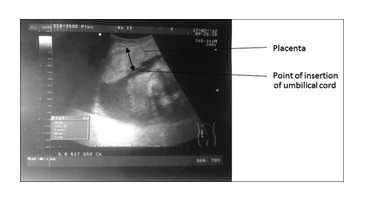 Relationship between Sonographic Placental Thickness and Gestational Age in Normal Singleton Fetuses in Enugu, Southeast Nigeria