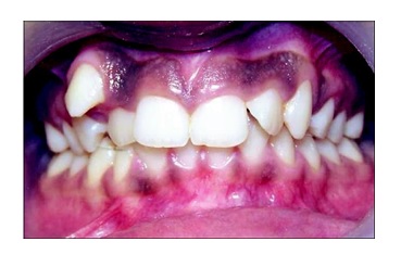 Scalpel Depigmentation and Surgical Crown Lengthening to Improve Anterior Gingival Esthetics